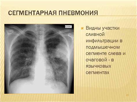 Внегоспитальная полисегментарная пневмония: симптомы, причины, лечение