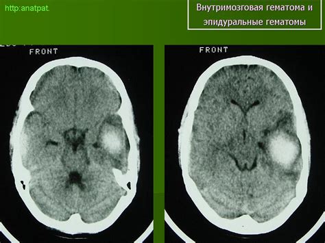 Внешние симптомы разрешающейся гематомы