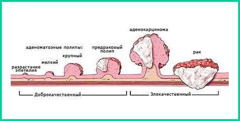 Внешний вид полипов