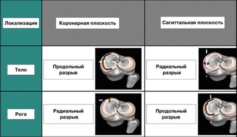 Внутренний мениск: степени повреждения и диагноз по Stoller