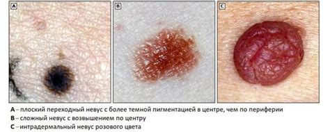 Внутридермальный папилломатозный невус