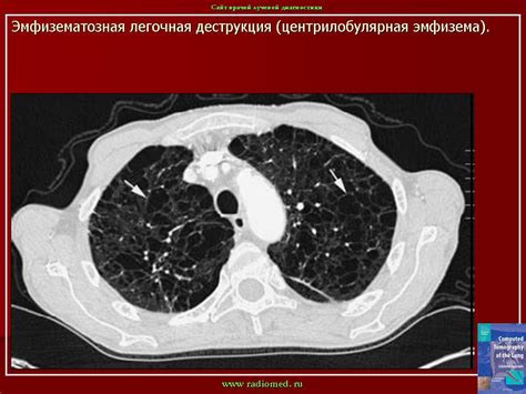 Внутридольковая эмфизема легких на КТ: