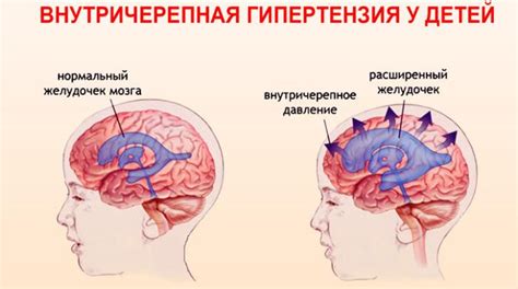 Внутричерепная гипертензия: основные признаки