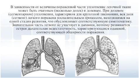 Вовлечение легочной ткани: сущность и значение