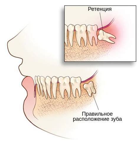 Водная ретенция в организме