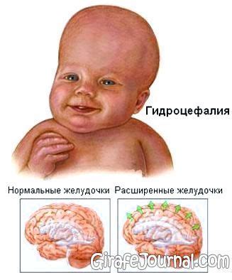 Водянка у детей – причины, симптомы и лечение