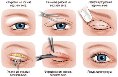 Воздействие травм и операций на веки