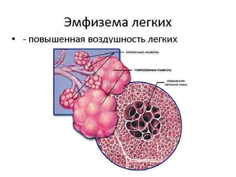 Воздушность легких повышена