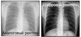 Возможности и преимущества цифрового рентгена легких: