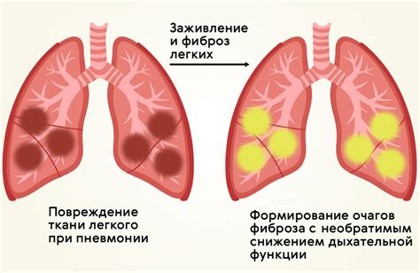 Возможность длительного бессимптомного течения болезни