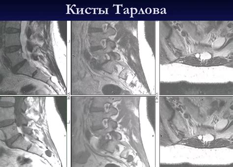 Возможные методы лечения и их эффективность при повышенной позиции левой маточной артерии