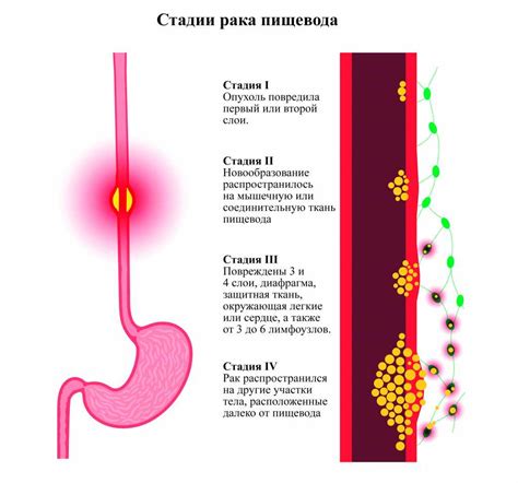 Возможные осложнения гиперемии слизистой оболочки пищевода