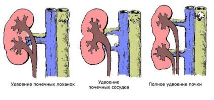 Возможные осложнения и последствия удвоения почек