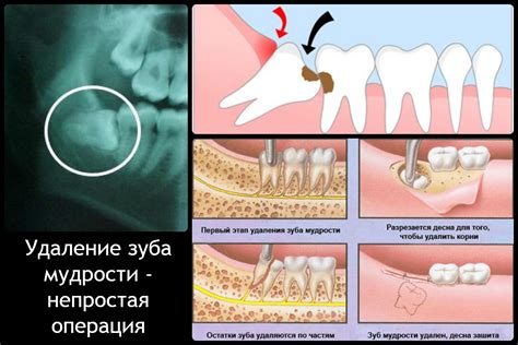 Возможные осложнения после лечения полого зуба