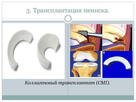 Возможные осложнения при мениске 3 степени