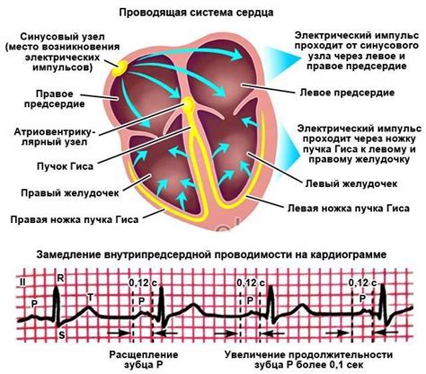 Возможные осложнения при нарушении желудочковой проводимости сердца 