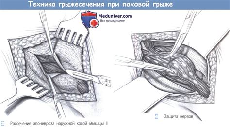 Возможные осложнения при неуточненной паховой грыже