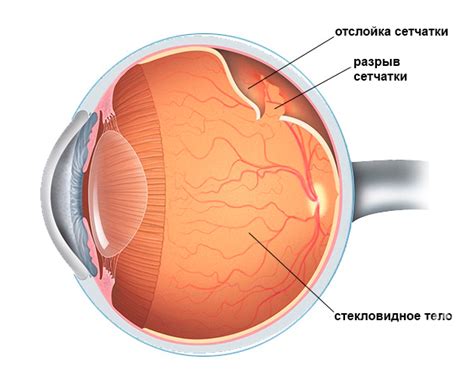 Возможные осложнения при прижигании сетчатки