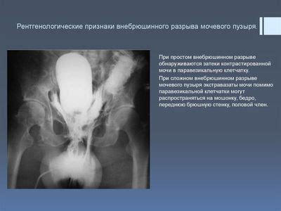 Возможные осложнения тура мочевого пузыря у мужчин