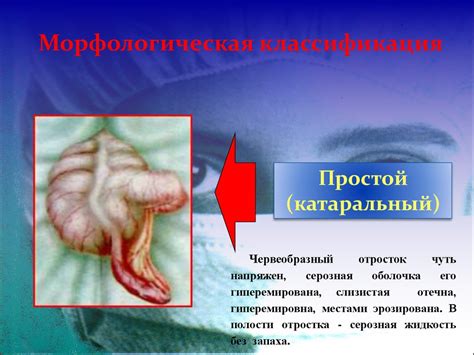 Возможные последствия невизуализации червеобразного отростка