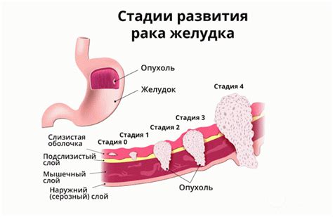 Возможные последствия отсутствия распада опухоли при раке желудка