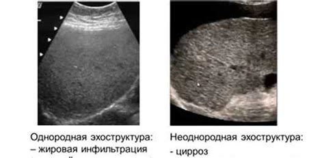 Возможные последствия повышенной эхогенности печени