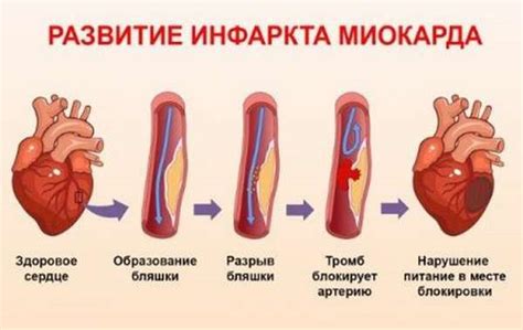 Возможные причины незначительных изменений миокарда