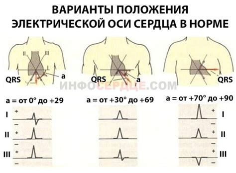 Возможные причины отклонения ЭОС влево