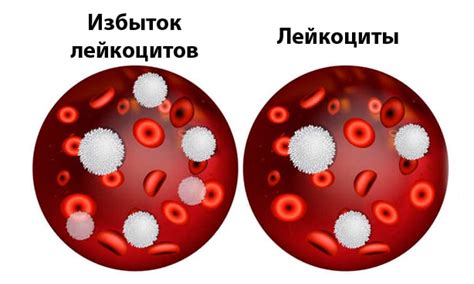 Возможные причины повышения лейкоцитов