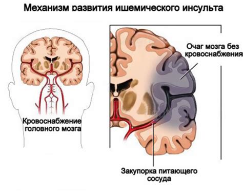 Возможные причины развития хронической ишемии головного мозга 1 степени