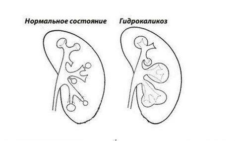 Возможные причины расширения чашечек