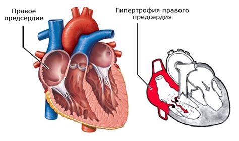 Возможные причины расширенного правого предсердия