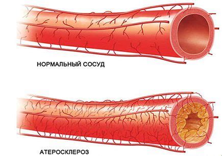 Возможные причины уплотнения стенок сосудов