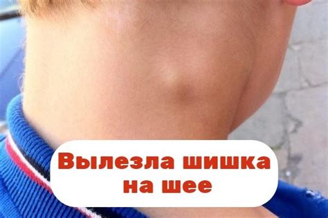 Возможные причины шишки на шее