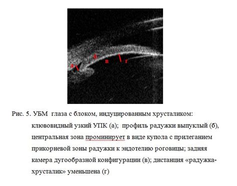 Возможные проблемы с плотным хрусталиком глаза