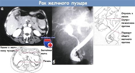 Возможные симптомы и диагностика анэхогенности полости желчного пузыря