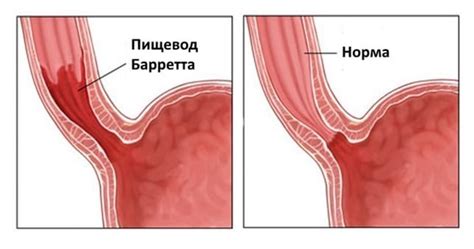 Возникновение пищевода Барретта