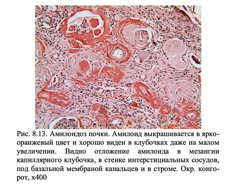 Возникновение утолщения коркового слоя лимфоузла