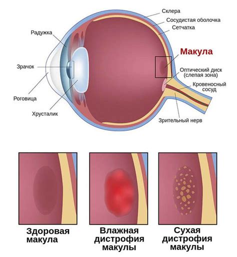 Возрастная дегенерация макулы