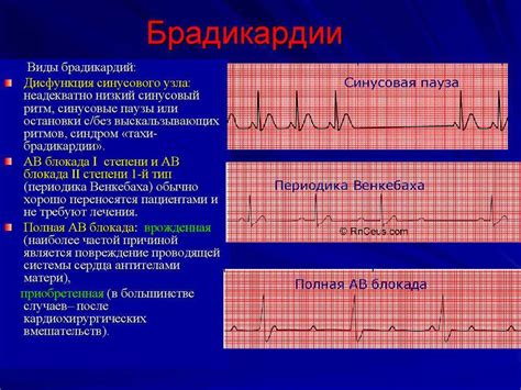 Возрастные особенности синусовой брадикардии