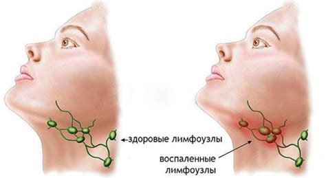 Воспаление лимфоузла под ухом: