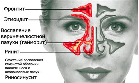 Воспаление синусов: не только насморк