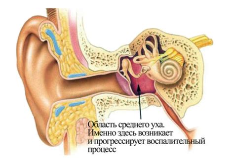 Воспаление среднего уха: