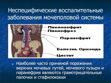 Воспалительные заболевания мочевых путей и боли в нижнем животе