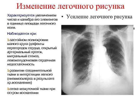 Воспалительные процессы и усиление легочного рисунка