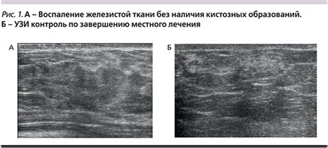 Воспалительные процессы молочных желез: влияние на жидкость в груди