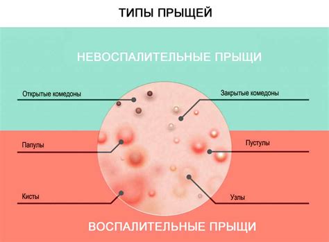 Воспалительные прыщи: папулы и пустулы