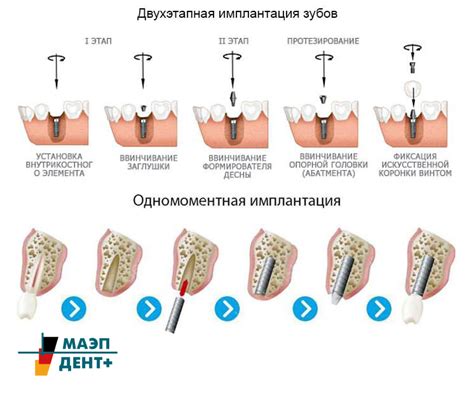 Восстановление здоровья зубов: важные аспекты и методы восстановления