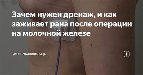 Восстановление и заживление: о том, как рана после операции на брюшной полости исцеляется