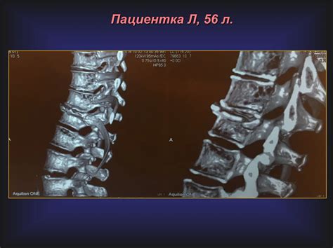 Восстановление после компрессионных переломов позвонков